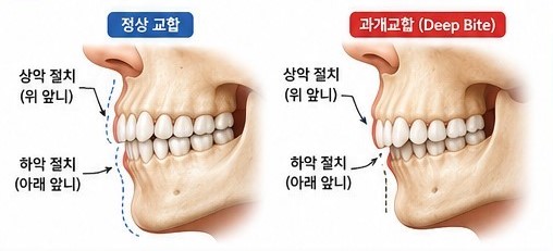 과개교합 00.jpg