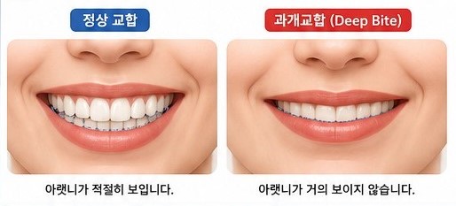 과개교합 01.jpg