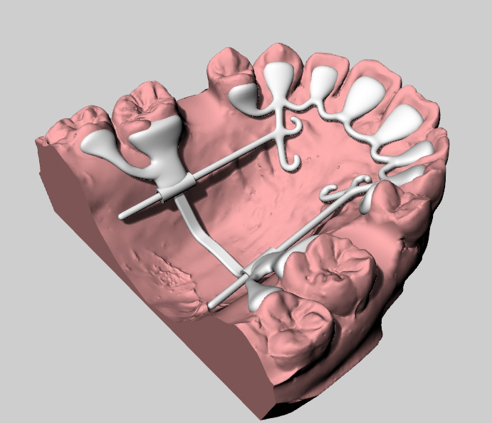 KILBON 교정장치 3D 모델 — 뷰 2