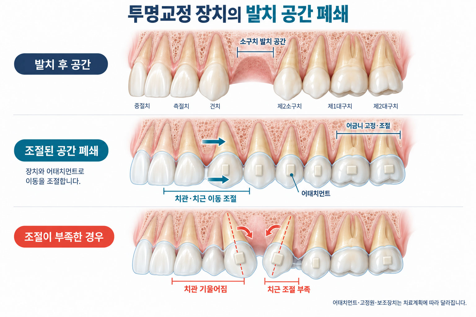 발치 공간 폐쇄 치아이동 비교 다이어그램 — 조절된 이동과 기울어짐