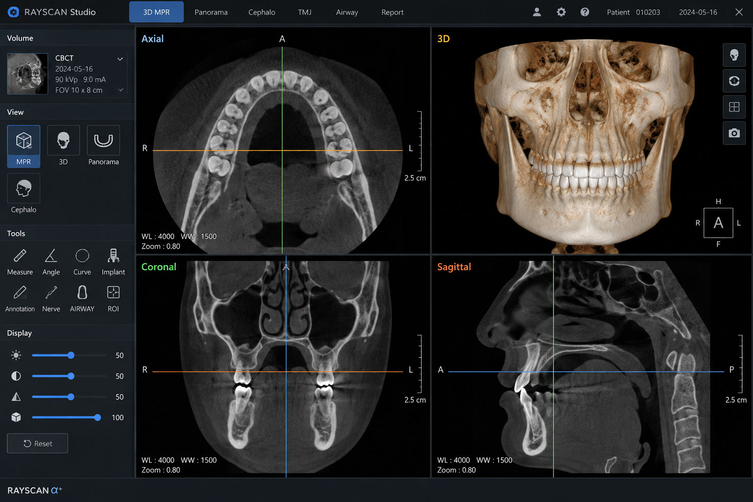 CBCT 3차원 골격 영상