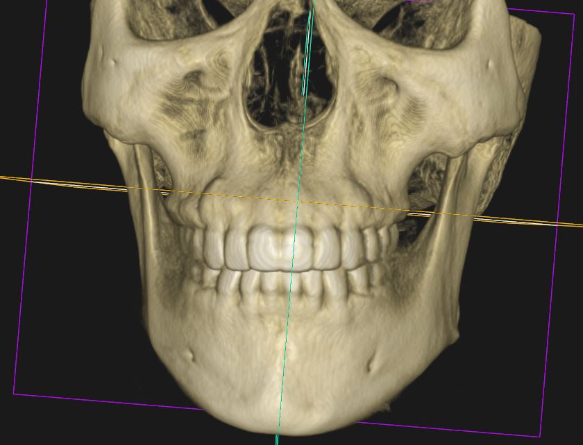재교정 CBCT 검사 — 3차원 골격 영상