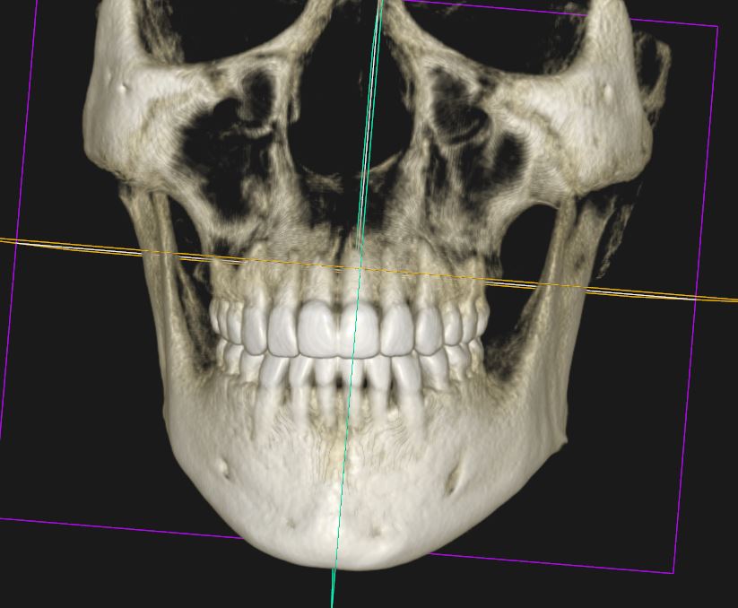 재교정 CBCT 단면 — 치조골 범위 확인