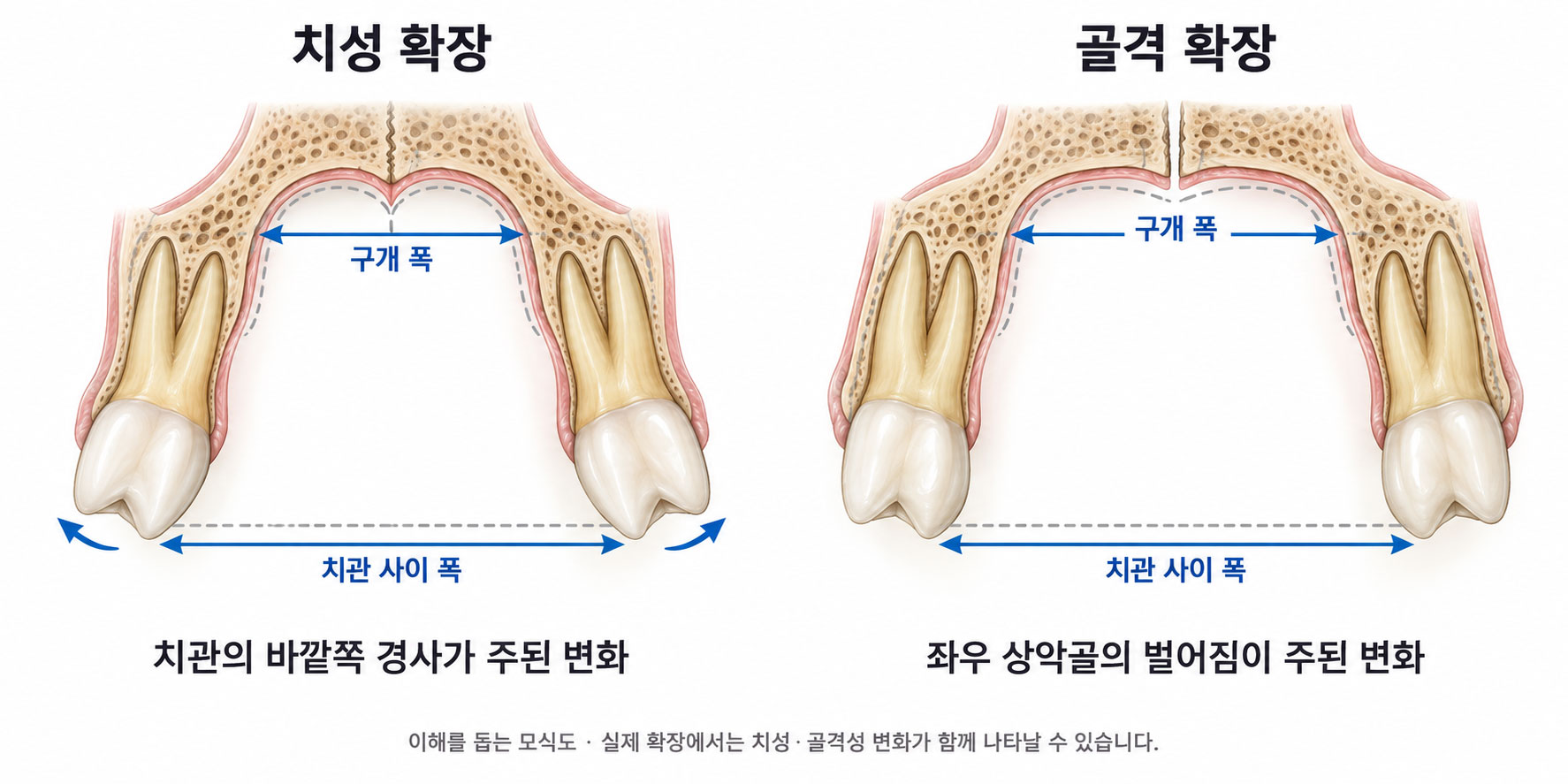 치성 확장과 골격 확장의 차이 개념도