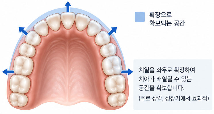 공간 확보 방법 — 악궁확장
