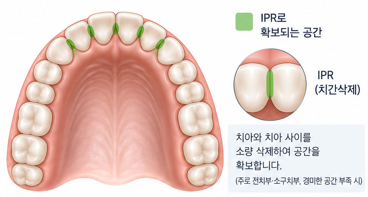 공간 확보 방법 — IPR