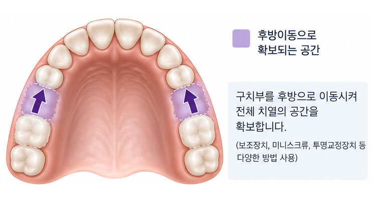 공간 확보 방법 — 후방이동