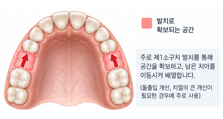 공간 확보 방법 — 발치