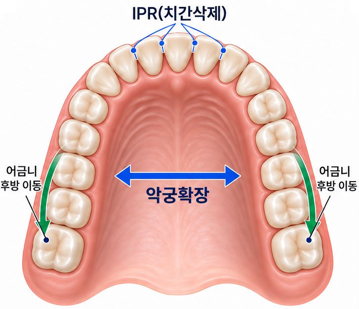 비발치교정 — 악궁확장·IPR·후방이동으로 공간 확보