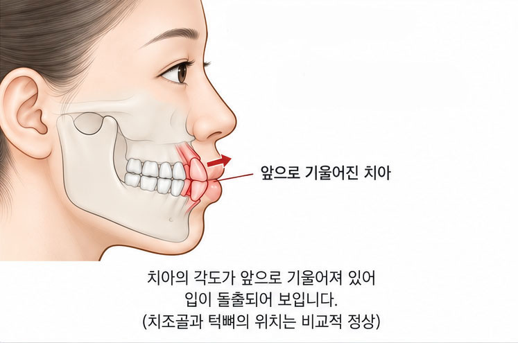 치아 기울기(치성) 돌출