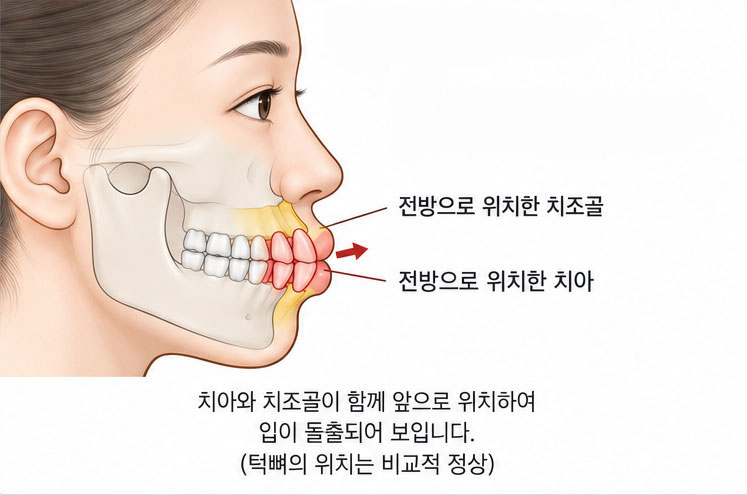 치아·치조골 전방 위치
