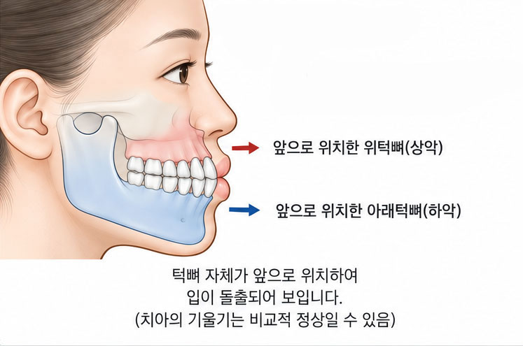 골격성 돌출