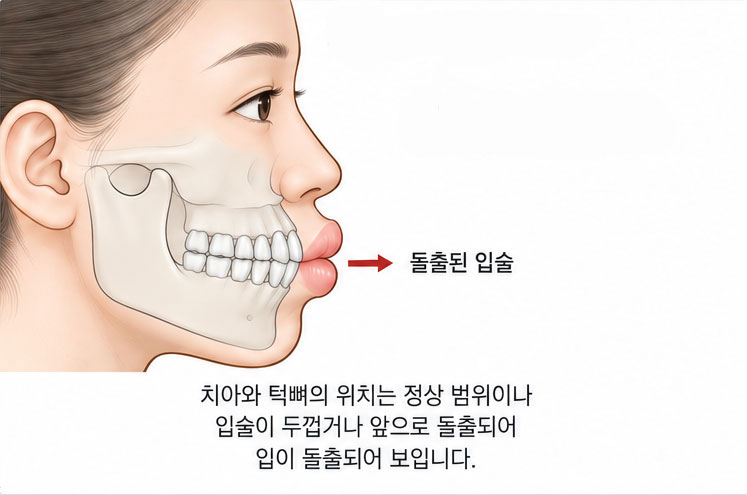 입술 요인