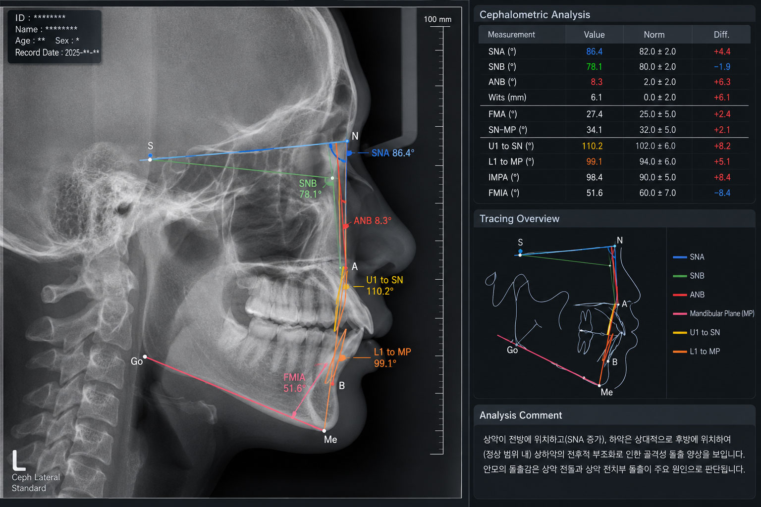 Cephalometric 계측 분석 화면