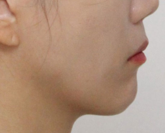 돌출입교정 치료 후 측면 안모