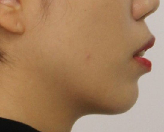 돌출입교정 치료 전 측면 안모