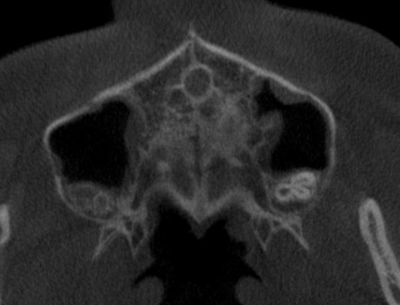 구개봉합부 CBCT 단면 1