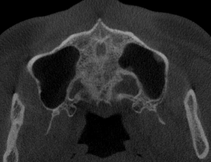구개봉합부 CBCT 단면 2