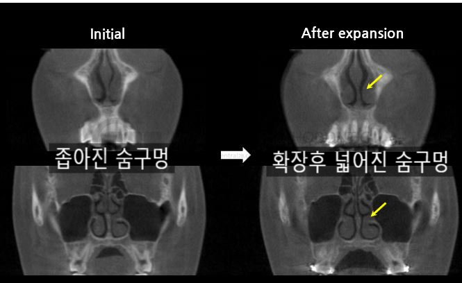 MARPE 치료 전후 CBCT — 상악골 확장과 비강 폭 변화