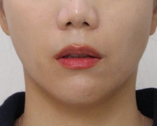 돌출입교정 치료 후 정면 안모