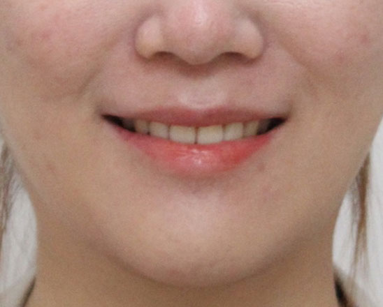 거미스마일 치료 후 스마일