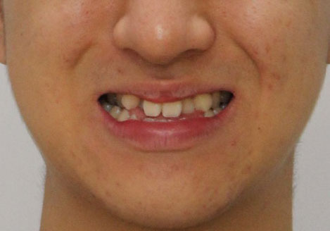 좁은 미소 — buccal corridor가 넓게 보이는 예