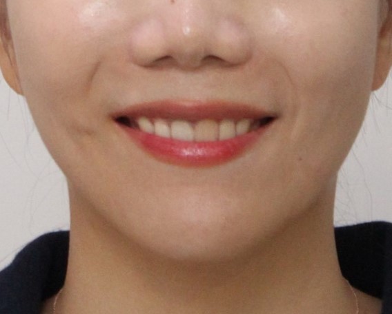 돌출입교정 치료 후 스마일