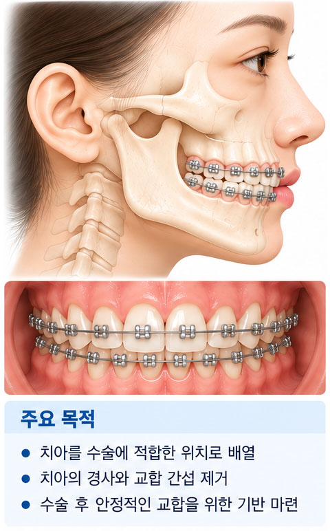 수술 전 교정 단계 도해