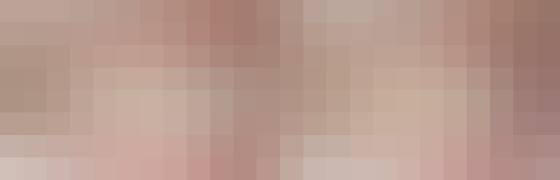 투명교정 : 부분교정 (회원 전용)